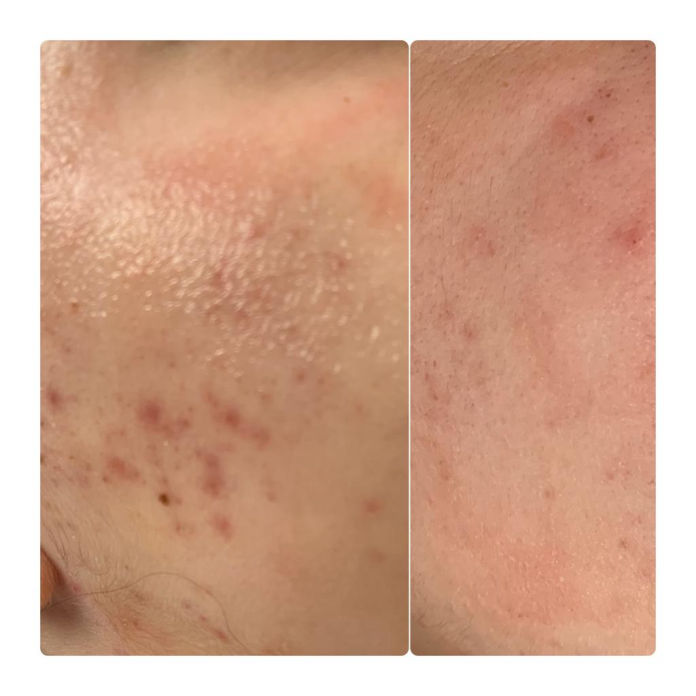 Needling Akne Studio Bad Langensalza MK Beautyart Academy