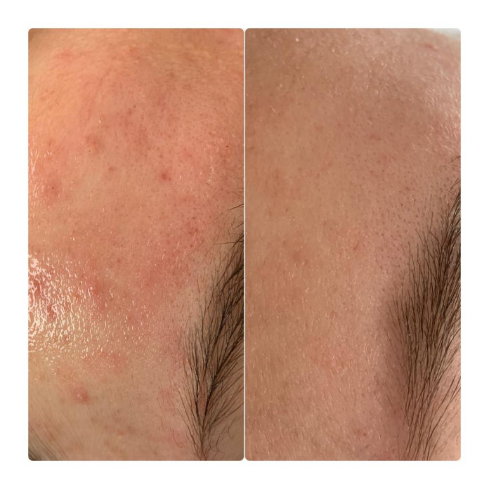 Behandlung Akne in Thüringen MK Beauty Art Academy