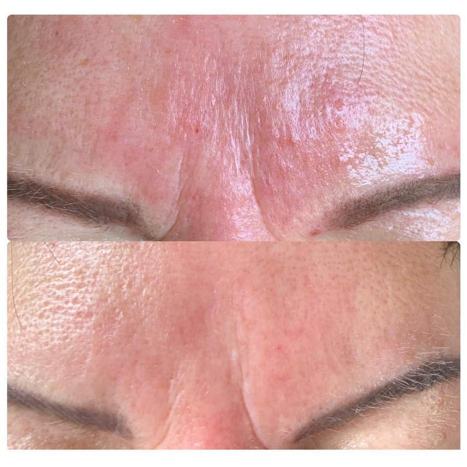 Nachbehandlung Microneedling in Thüringen MK Beauty Art Academy