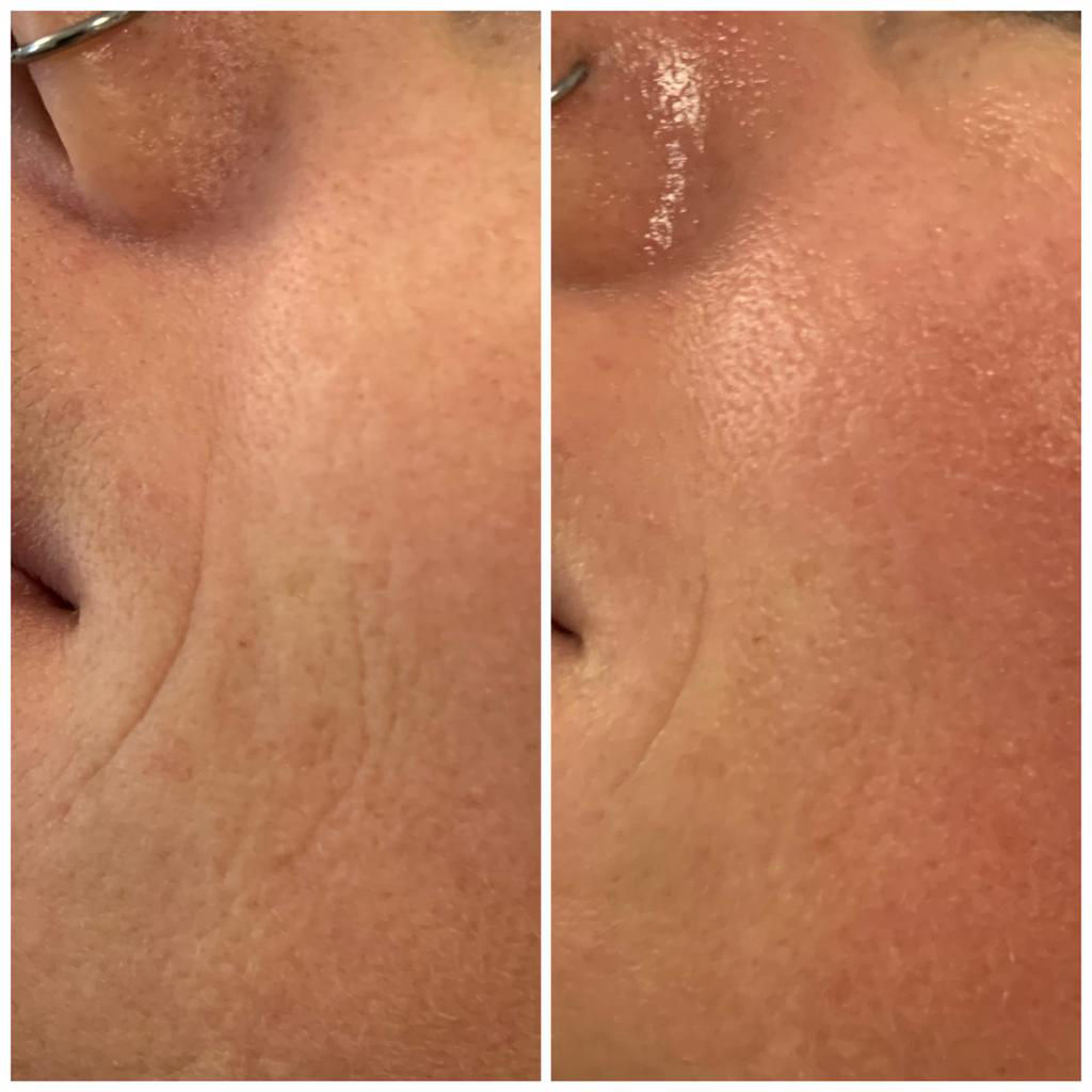 Nachbehandlung Microneedling in Thüringen MK Beauty Art Academy