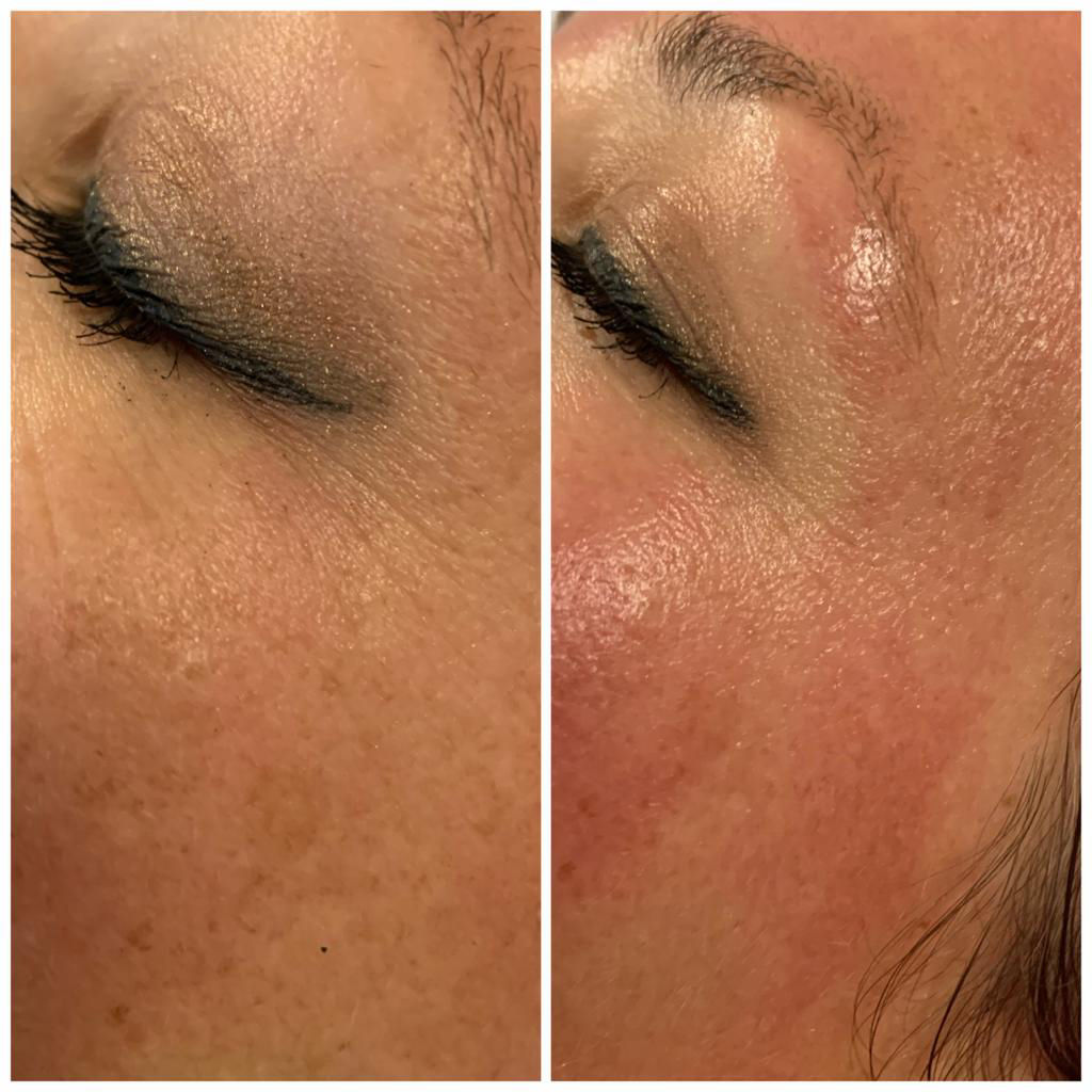 Nachbehandlung Microneedling in Thüringen MK Beauty Art Academy