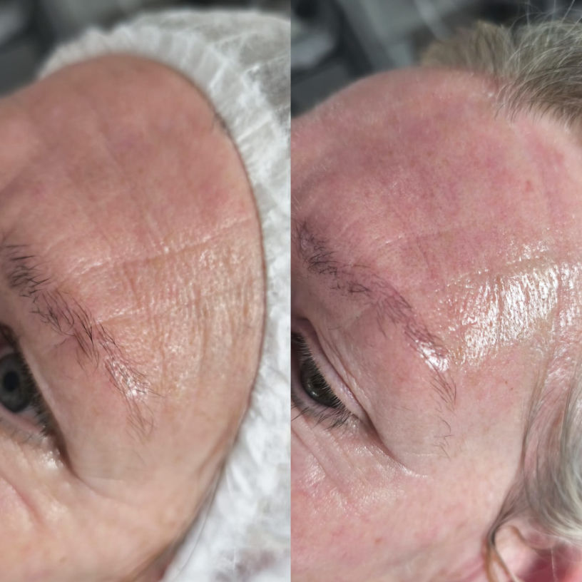 FUTURACONTOUR® Antiaging ohne Nadeln Thüringen Studio MK Beauty Art Bad Langensalza