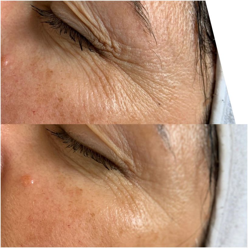 FUTURACONTOUR® Antiaging ohne Nadeln Thüringen Studio MK Beauty Art Bad Langensalza