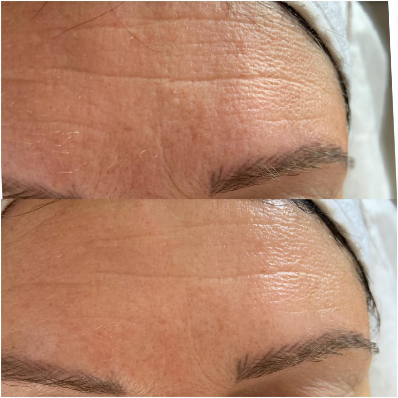 FUTURACONTOUR® Antiaging ohne Nadeln Thüringen Studio MK Beauty Art Bad Langensalza